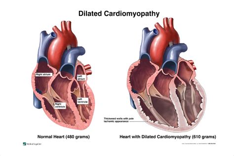 non dilated lv|dilated cardiomyopathy most common cause.